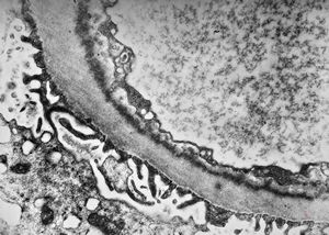 M,37y. | type I membranoproliferative glomerulonephritis (mesangiocapillary)
